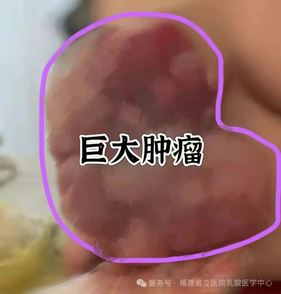 图片[2]-【省立乳腺·人文】当乳房遇见“叶状”肿瘤：不只是疾病，更是生命与尊严的守望-华闻时空