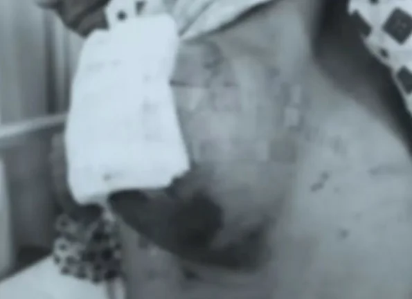 图片[1]-【省立乳腺·人文关怀】37岁男子胸前长了”足球大”肿瘤！省立乳腺团队联手拆弹，这个”小硬结”千万别忽视-华闻时空